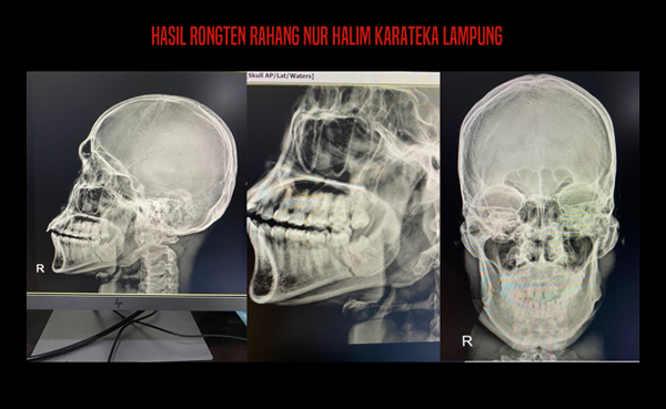Barbarisme di Arena Kareta PON Papua, Tulang Rahang Karateka Lampung Cidera Sangat Serius