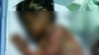 Sekujur Tubuh Melepuh, Bocah TK di Lampung Utara Ini Butuh Uluran Tangan