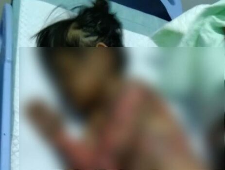 Sekujur Tubuh Melepuh, Bocah TK di Lampung Utara Ini Butuh Uluran Tangan