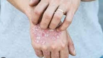 Puluhan Penderita Kusta Ditemukan di Lampung Utara