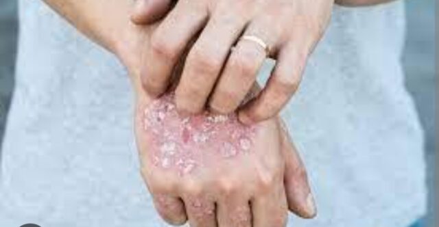 Puluhan Penderita Kusta Ditemukan di Lampung Utara